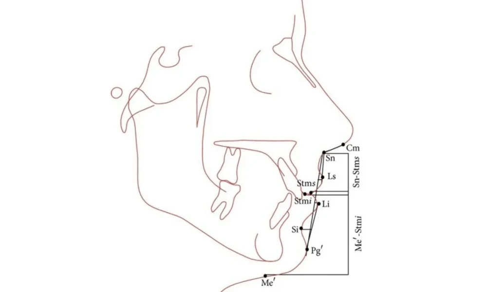 Clinical photo from Emma's chin implant augmentation case